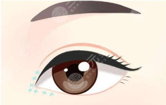 韩式双眼皮手术有哪些?