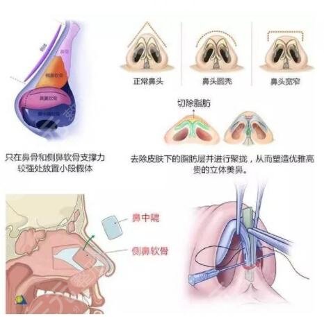 自体软骨隆鼻的手术流程