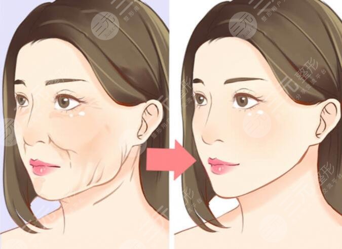 面部下垂整形多久恢复正常状态？恢复期通常为1个月！