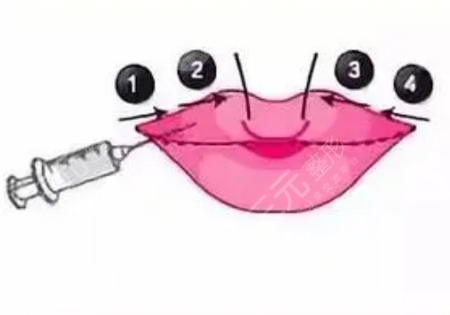 玻尿酸丰唇多久消肿？能维持多久？