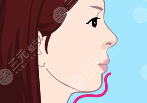玻尿酸填充下巴有什么副作用？