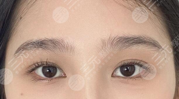 上海国际医学中心整形科全切双眼皮案例分享