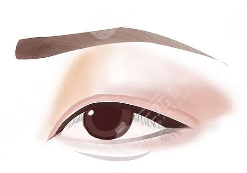 双眼皮修复手术怎么做