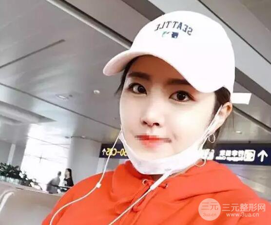 综合隆鼻前后对比照片案例