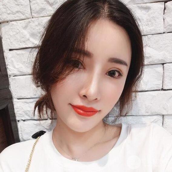 银川崔大夫博士丽朱杰自体脂肪丰面颊恢复记录附对比图片