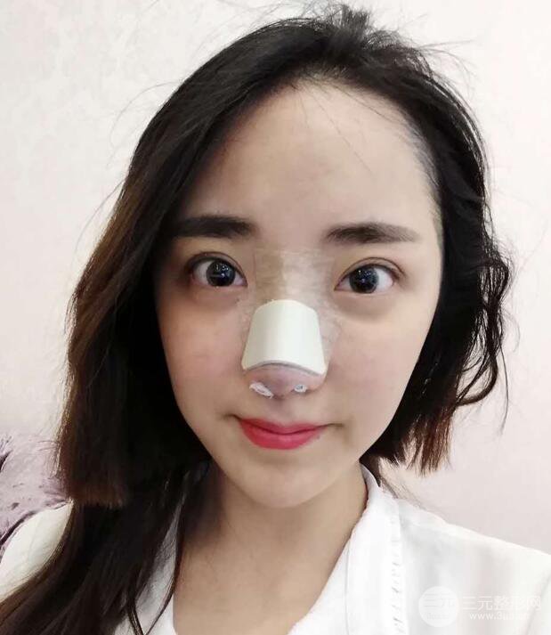 东莞宝格丽韦文奇隆鼻整形果图分享，对比曝光