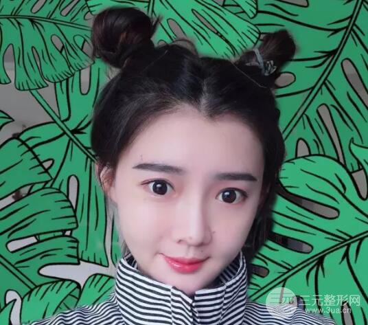 脂肪填充全脸恢复过程图