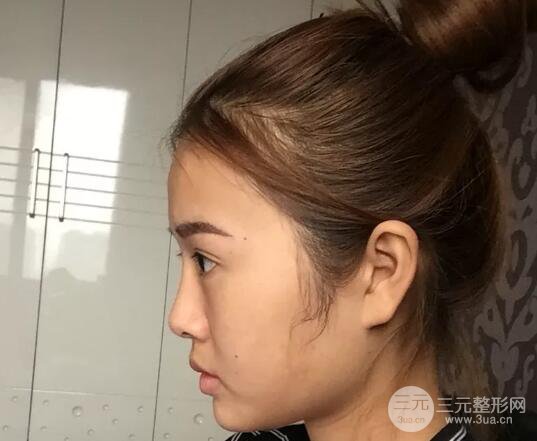 我的自体脂肪面部填充日记