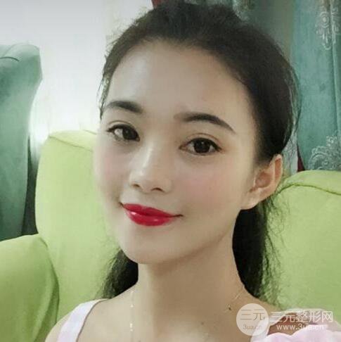 沧州静港医疗美容金翰成隆鼻整形真人恢复对比图，恢复后像杨颖又像赵丽颖