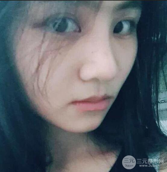 泉州亿星医疗美容闵英俊膨体隆鼻果展示