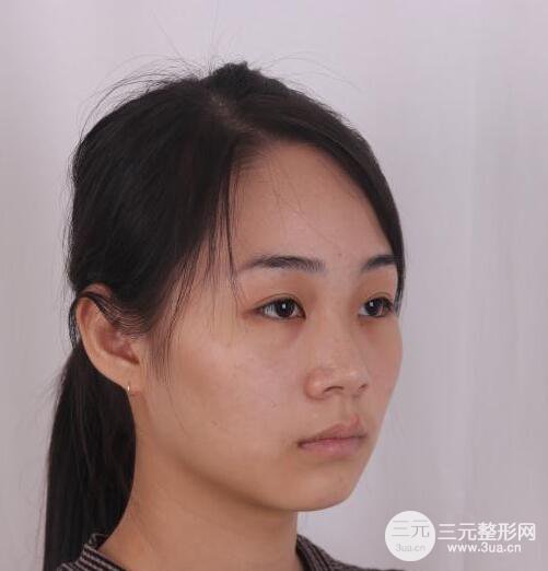 杭州恒颜医疗美容赵德星隆鼻整形手术恢复过程图