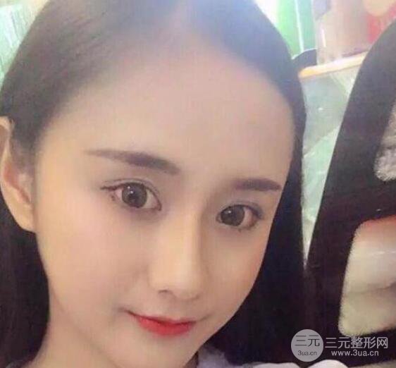 三亚三仁医疗美容于德印全切双眼皮+开眼角一个月恢复图来辣