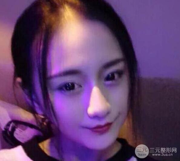 三亚三仁医疗美容于德印全切双眼皮+开眼角一个月恢复图来辣