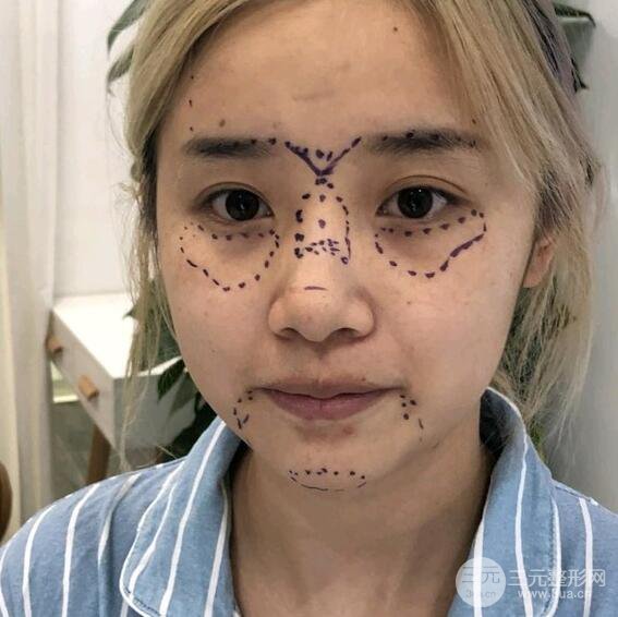 自体脂肪填充面部+隆鼻整形，变美就是这么简单