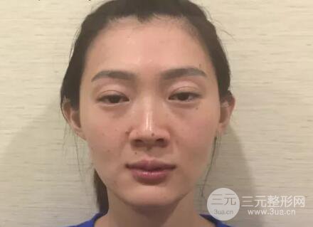 脂肪填充全脸恢复过程图