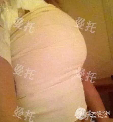 分享我的曼托隆胸图片