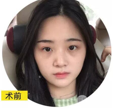 隆鼻恢复过程图