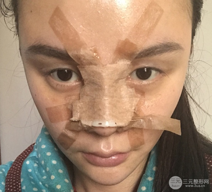 隆鼻整形三个月记录，恢复后立体度不输外国人