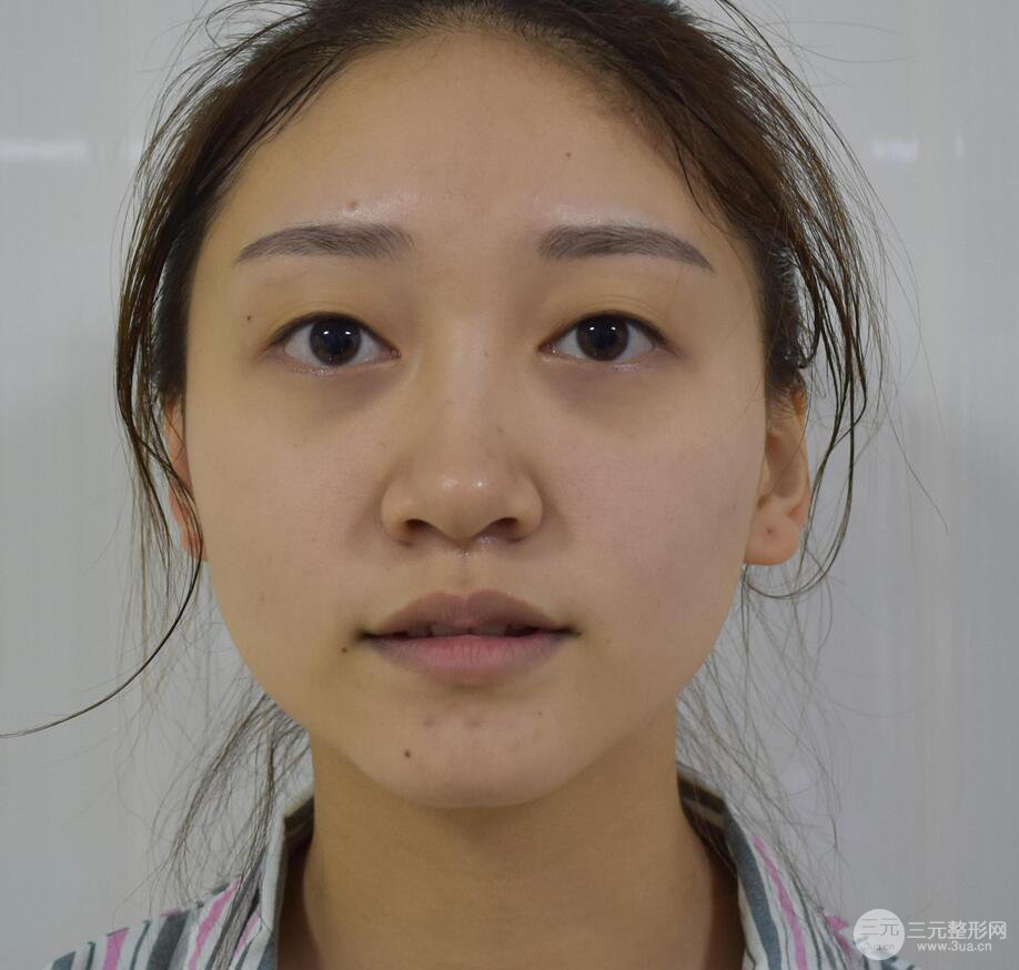 广州名韩医疗美容卓敬锡“隆鼻整形+自体脂肪填充全脸”案例分享，整完有点像景甜