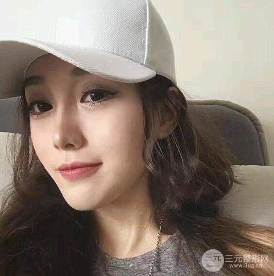 苏州芘丽芙华美甘月圆自体脂肪填充全脸恢复记录