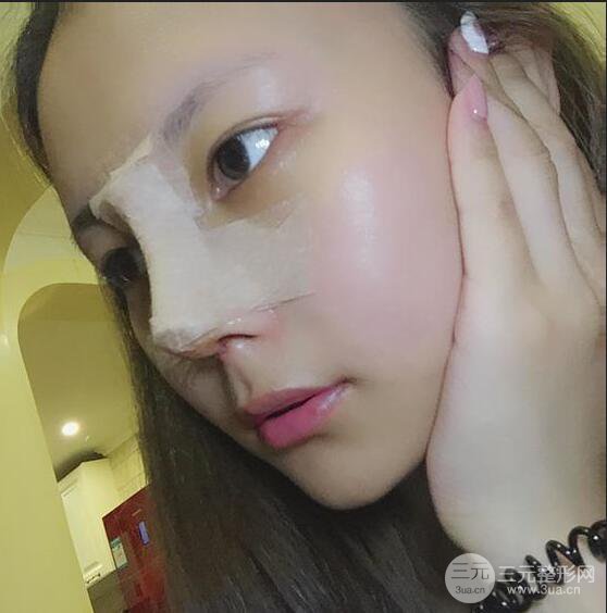 杭州恒颜医疗美容赵德星肋软骨隆鼻术后六十天全记录