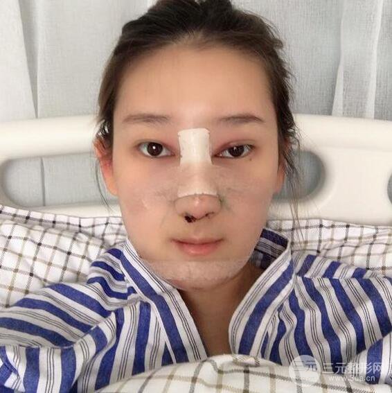 三亚三仁于德印肋软骨隆鼻+硅胶垫下巴恢复对比图