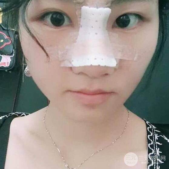 泉州亿星医疗美容闵英俊膨体隆鼻果展示