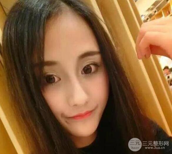 三亚三仁医疗美容于德印全切双眼皮+开眼角一个月恢复图来辣