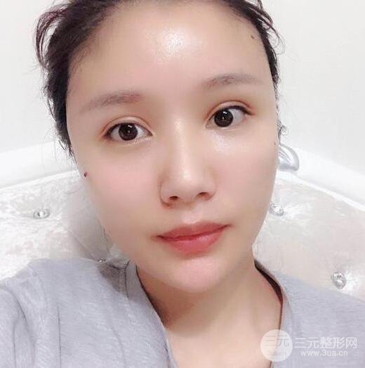 辣妈做了自体脂肪填充全脸，对比图分享