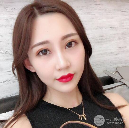 割双眼皮两个月是啥样，妹子公开恢复记录