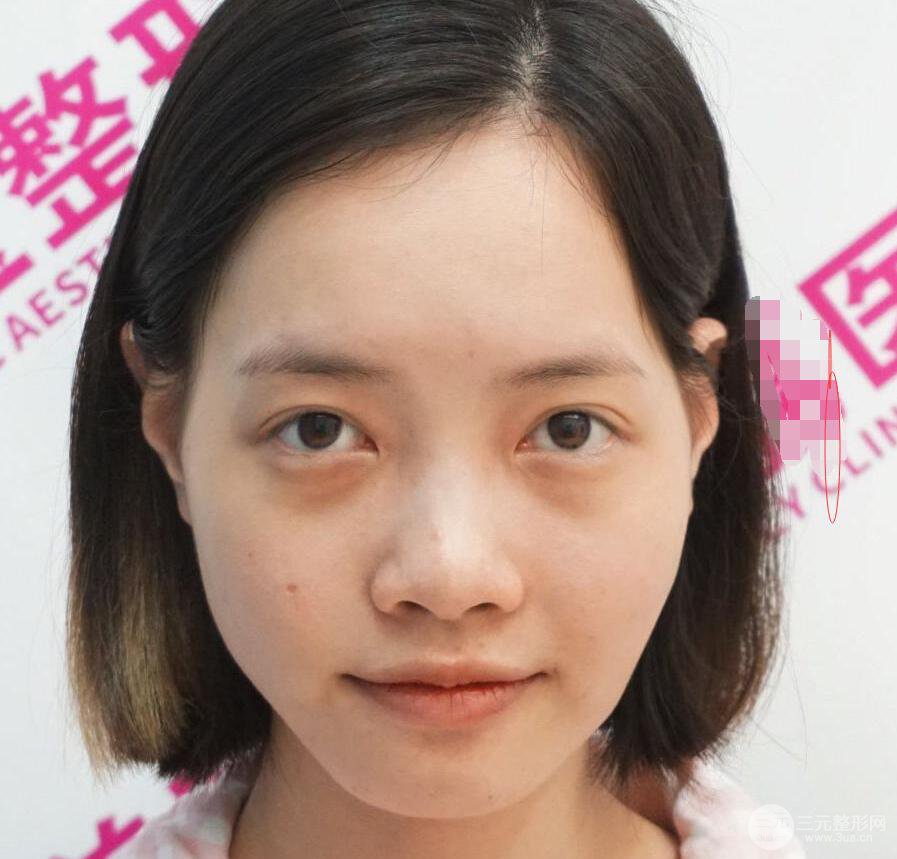 上海华美李健自体脂肪详细部填充果图，少女脸经久不衰的秘密在这里