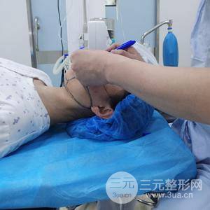 自体脂肪填充全脸恢复记录