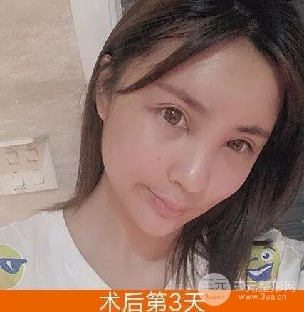 我的自体脂肪脸部填充日记