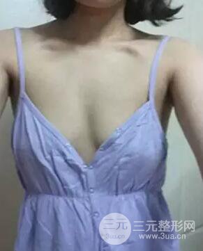 假体隆胸分享日记