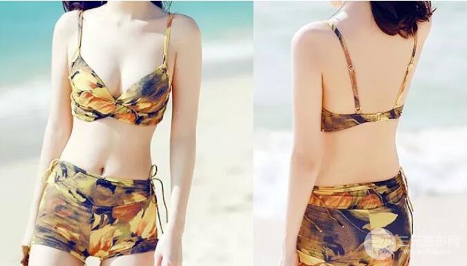 腹腰吸脂三个月图片