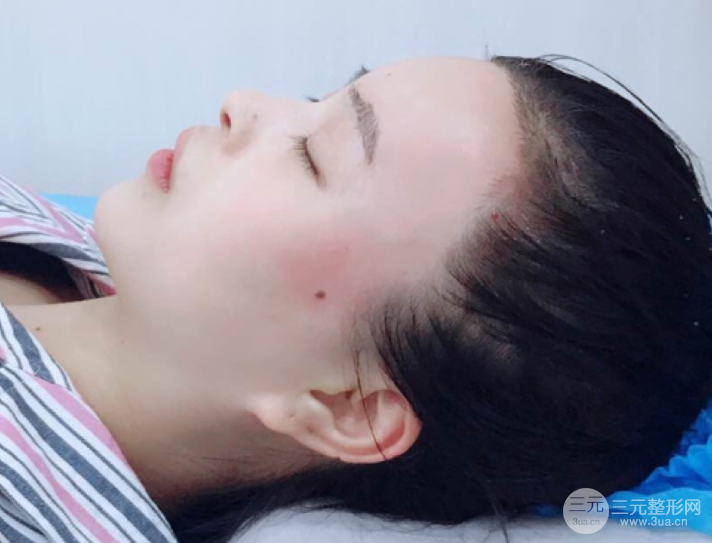 自体脂肪填充一个月真实恢复图片，恢复后连闺蜜都惊艳辣