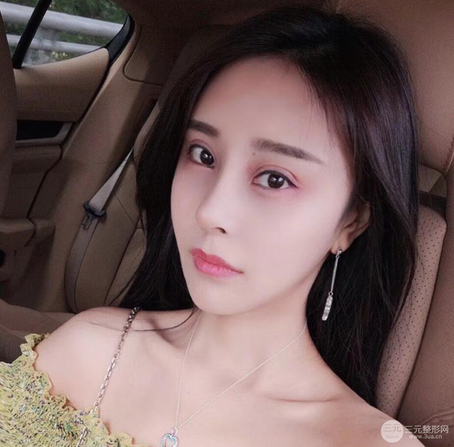 青岛海伦整形朱洪涛肋软骨隆鼻恢复记录