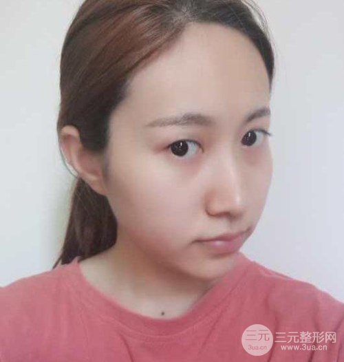全切双眼皮术后三个月对比图曝光，告别小眼睛就是这么简单
