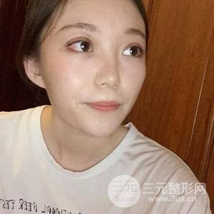 切开双眼皮+上睑下垂矫正术前术后果对比图
