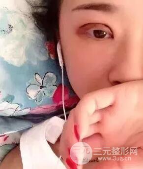 切开双眼皮15天果图