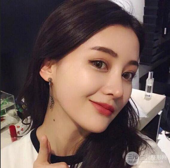 沧州静港医疗美容金翰成隆鼻整形真人恢复对比图，恢复后像杨颖又像赵丽颖