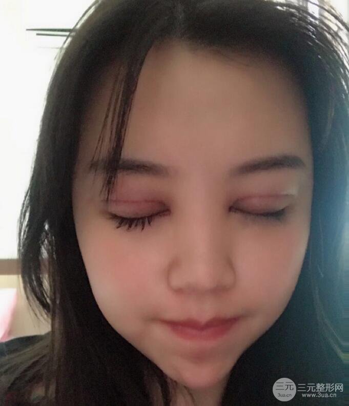 苏州芘丽芙华美孙培灵全切双眼皮真人恢复图曝光