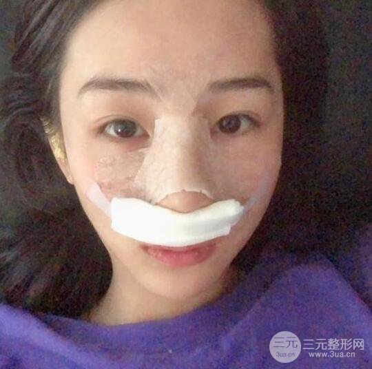 东莞宝格丽医疗美容韦文奇隆鼻整形60天恢复图片