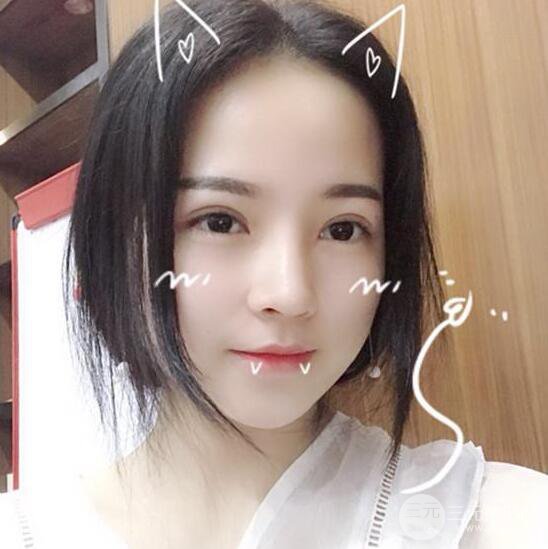 银川崔大夫博士丽医疗美容朱杰膨体隆鼻果反馈