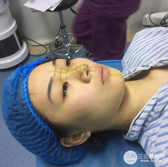 杭州恒颜医疗美容赵德星隆鼻整形手术恢复过程图