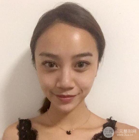 回民区张高贵医疗美容隆鼻恢复记录