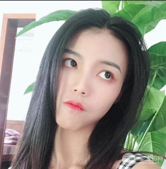 银川崔大夫博士丽朱杰硅胶隆鼻恢复图，轻松get精致脸