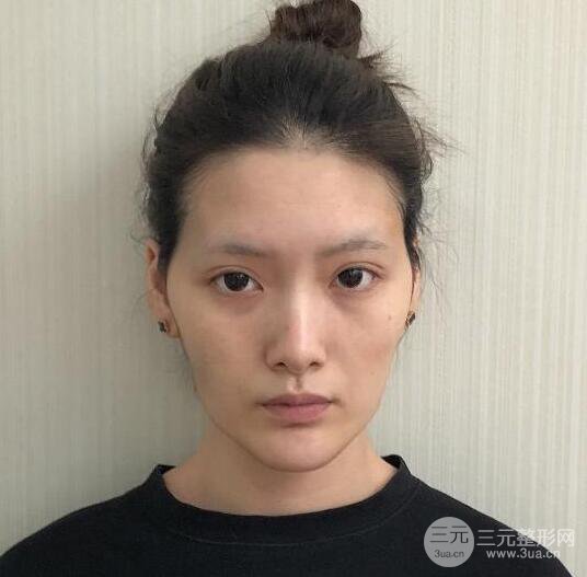 自体脂肪面部填充果真人反馈，附对比图