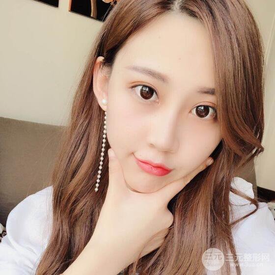 割双眼皮两个月是啥样，妹子公开恢复记录