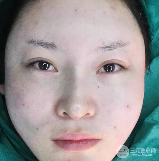 自体脂肪面部填充果怎么样？对比反馈